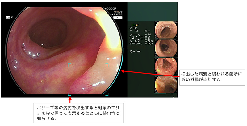 病変検出支援機能その1