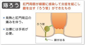 あな痔（痔ろう）