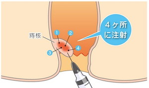 4箇所に注射