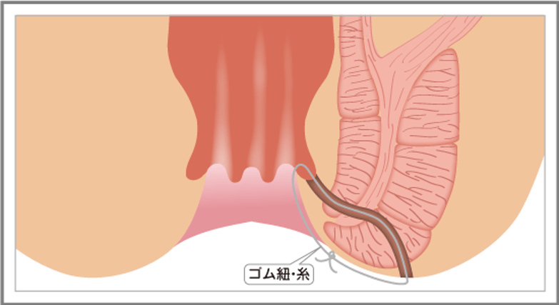 シートン法